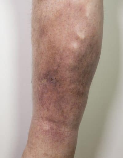 Severe skin damage due to varicose veins; high risk of ulcer formation