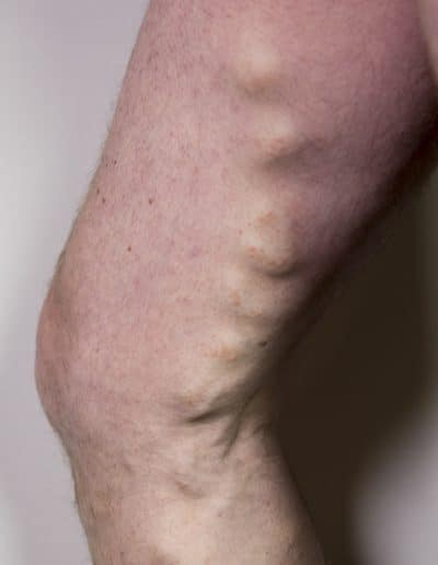 Large bulbous thigh varicose veins