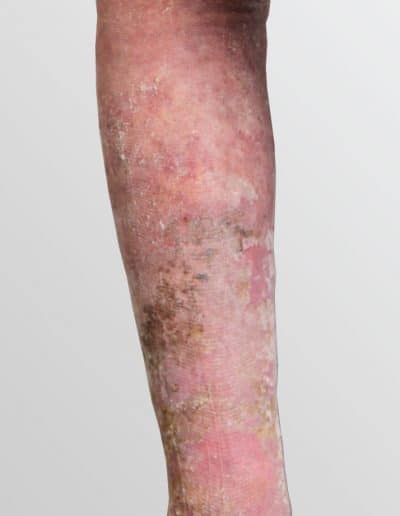 Venous eczema due to invisible varicose veins