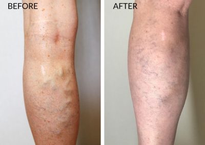 Before and After Vein Treatment