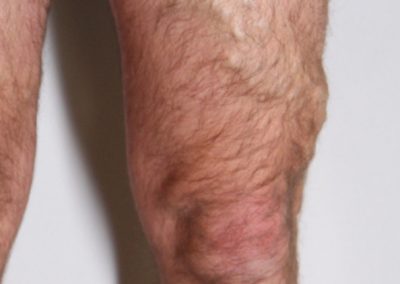 Varicose veins when standing