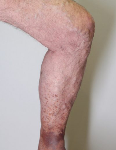 Dark skin staining on the leg