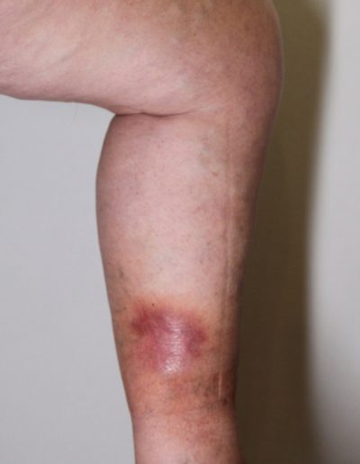 Acute painful inflammation on the leg